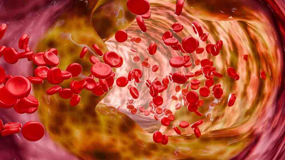 Περιφερική αρτηριοπάθεια: Διάγνωση, παράγοντες κινδύνου και σύγχρονες θεραπείες